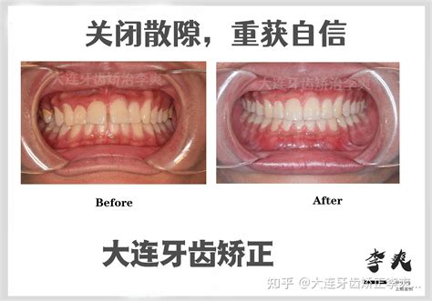 大门牙|门牙太大是一种什么体验？